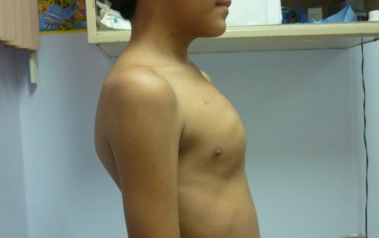 Pectus Excavatum: La deformidad Silenciosa que limita la respiración y el rendimiento físico